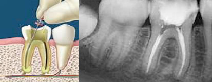 Endodoncia sin dolor