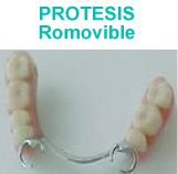 Prostesis dentales removibles
